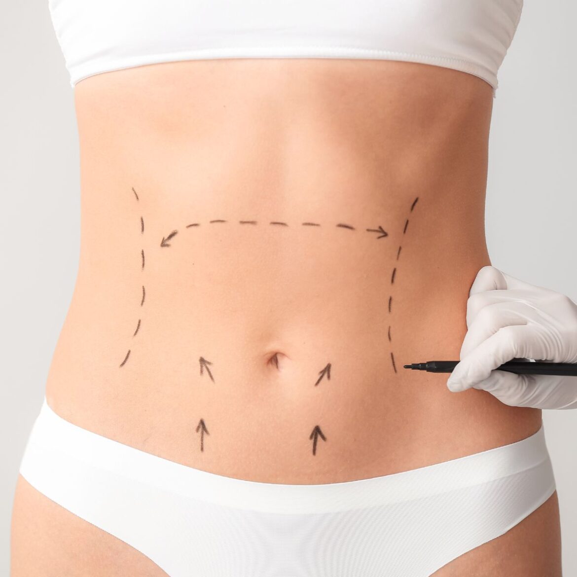 Por Que a Abdominoplastia é a Escolha Certa para Você em Florianópolis?